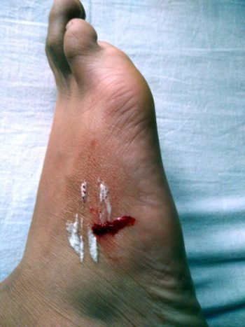 foot of a child with blood on it due to Leech Bite